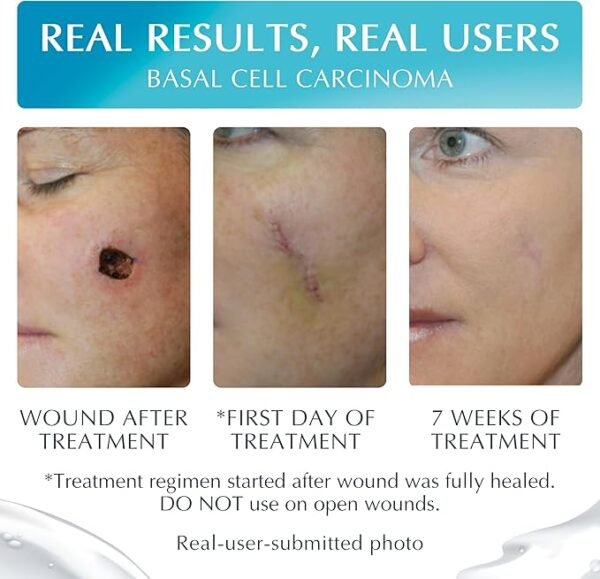 NewGel+E Advanced Silicone Scar Gel | Medical-Grade Formula with Vitamin E | Reduces Appearance of Surgical, Acne, Burn, C-Section, and Injury Scars | Softens, Flattens & Fades Old & New Scars | Fast-Drying, Non-Sticky